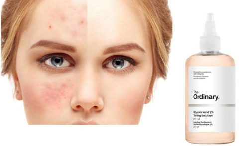 The Ordinary Glycolic Acid 7% Toning Solution before and after
